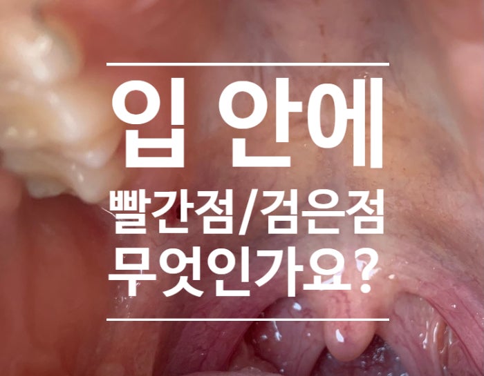 지식인 상담소) 입안에 빨간 점, 검은 점이 생겼어요? 괜찮을까요? (contusion), 입안에 피멍, 피멍울