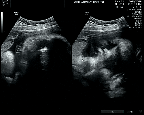임신후기 성장 기록 : 8개월 ~ 10개월 증상, 초음파