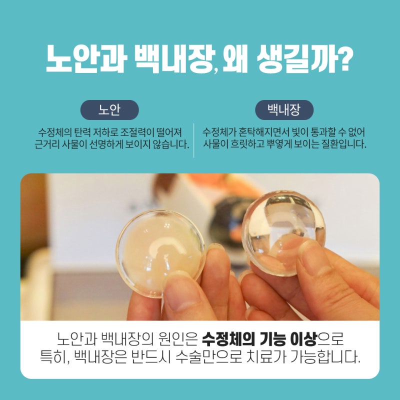 백내장 여부에 따라 다릅니다