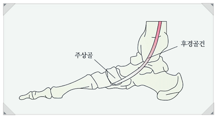  부주상골증후군 수술? 정형외과 전문의가 설명드립니다.
