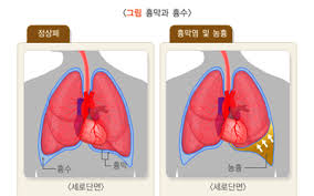  간호학과 흉수 흉막삼출 원인증상 병태생리진단검사 수술치료 늑막절제술 흉강천자 간호중재