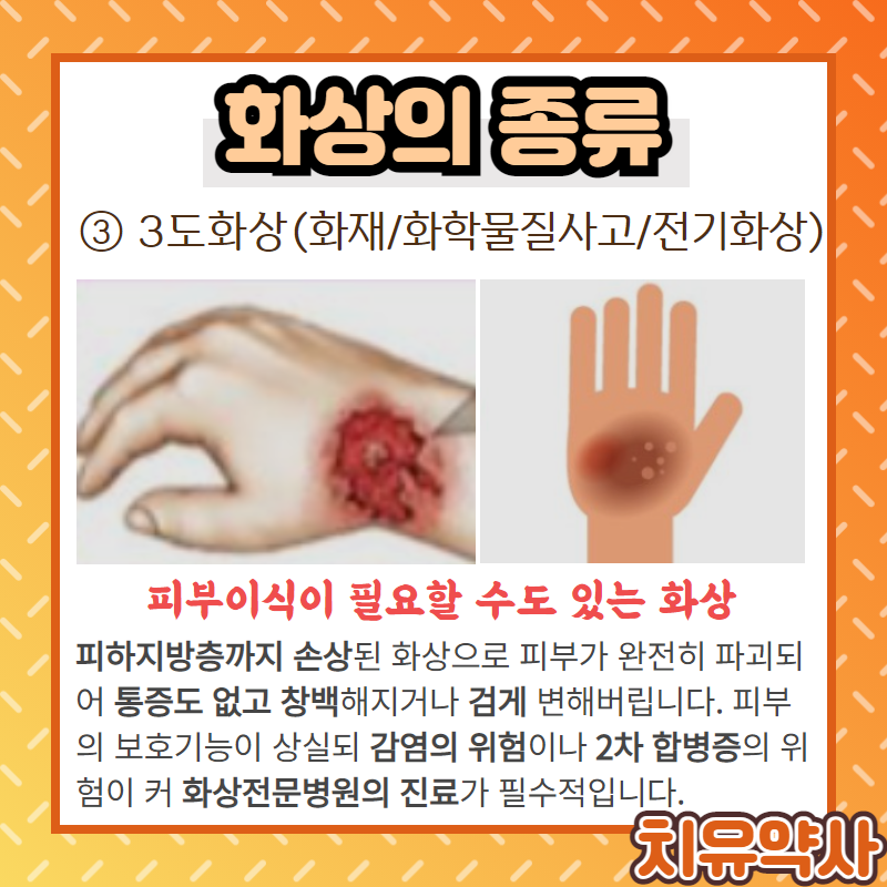 화상 입었을때! 약사가 알려주는 화상응급처치법 총정리(병원 꼭 가야하는 화상 종류) : 네이버 블로그