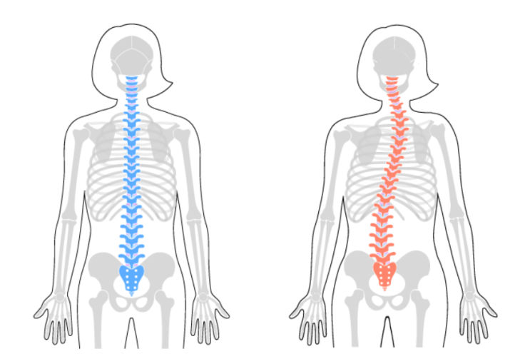  [자세교정비포애프터] 척추측만증Scoliosis 비포&애프터