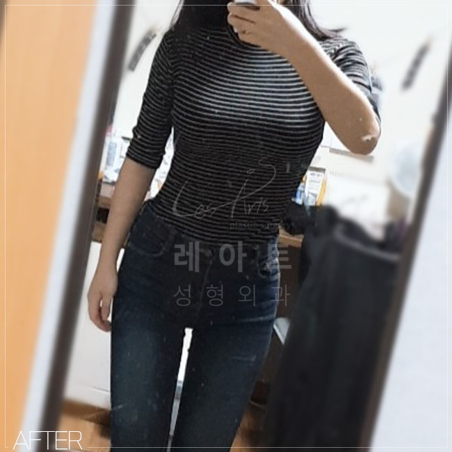  레아트성형외과는 가능해 네가 원하던 직각팔뚝 & 일자팔뚝