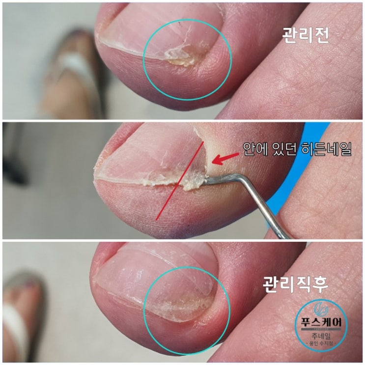 아파서 계속 자르다보니 더 깊이 파고 들어간 발톱 관리후기/성남수원수지보정동백죽전동/주네일/무좀파고드는내향성발톱손톱변형전문점