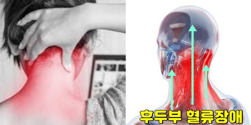 뒷머리 통증(왼쪽 오른쪽), 후두하근 3