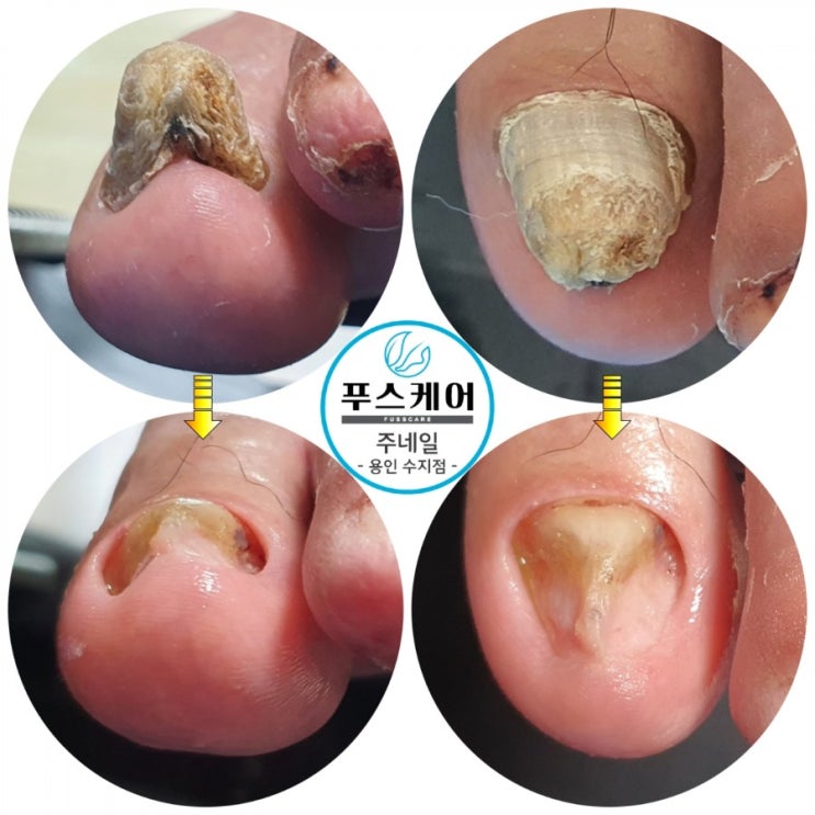 두껍고 솟아오른 발톱 할머니 관리후기/성남수원수지보정동백죽전동/주네일/무좀파고드는내향성발톱손톱변형전문점