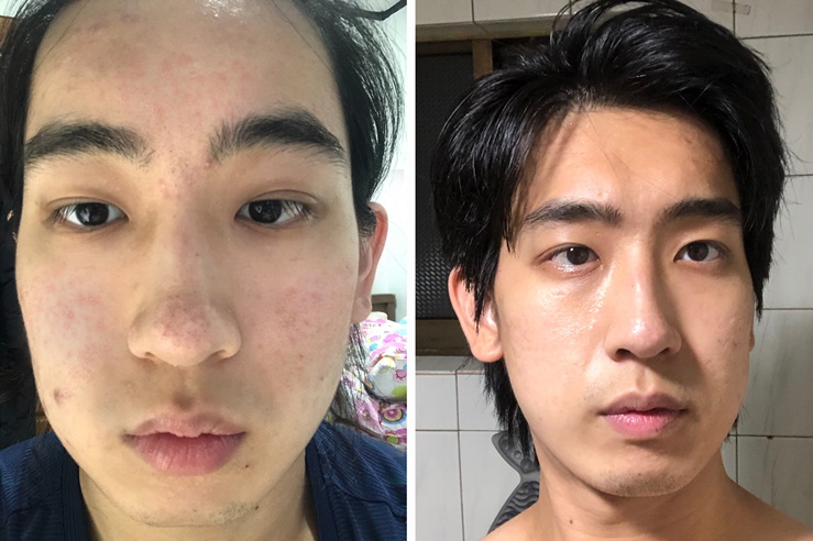  블랙헤드 제거 잘못했다면