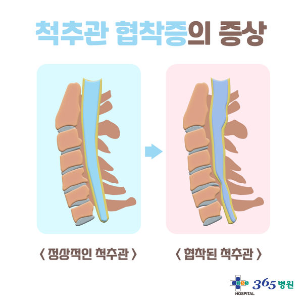 [창원마산 척추관절 디스크 365병원] 척추관협착증