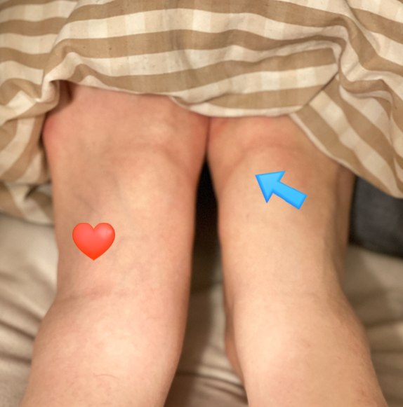  부종/요흔성부종/다리부종/손부종/하체부종/광고아님/과거의 내 손은 섬섬옥수, 발목은 얇았었나??/지금은 코끼리다리+오뎅손 ㅌ.ㅌ