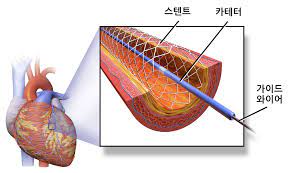  경피적관상동맥확장술PTCA 목적적응증 순서방법 주의사항 심근경색협심증 합병증예후