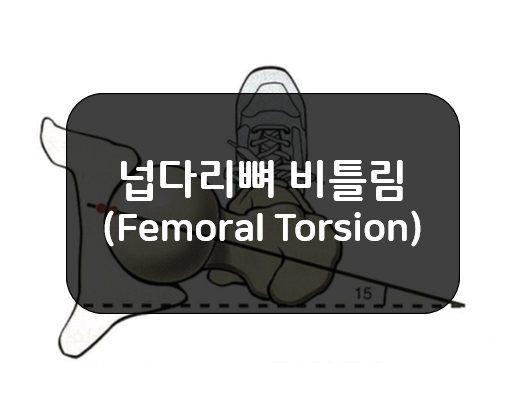 넙다리뼈 비틀림(Femoral Torsion) - 앞경사(Anteversion), 뒤경사(Retroversion)