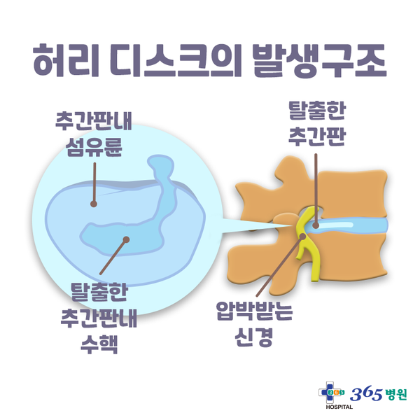  [창원마산 척추관절 디스크 365병원] 허리디스크(추간판 탈출증)