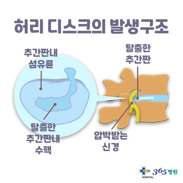 [창원마산 척추관절 디스크 365병원] 허리디스크(추간판 탈출증)