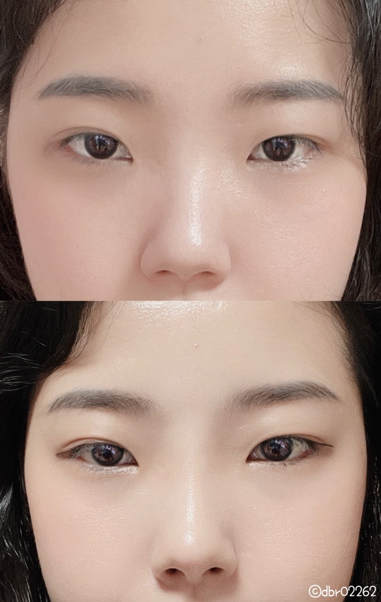 대구 코필러 생각만하다가 드디어 처음 받아본 솔직한 후기 대구 코필러 생각만하다가 드디어 처음 받아본 솔직한 후기