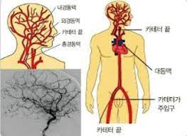  뇌혈관조영술 PET검사목적 순서방법 적응증금기환자 검사전후주의사항 병원건강검진준비 조영제단층촬영술