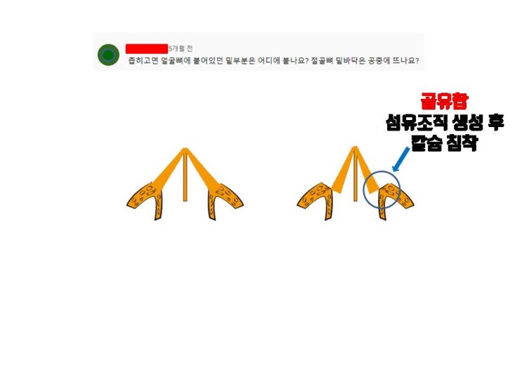  넓은 코, 휜 코 교정을 위한 코절골에 대한 질문, 답변 여기 다 있어요!!!