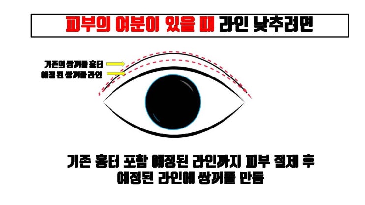  피부가 부족한 위눈꺼풀 소세지 쌍꺼풀 교정 위해 라인 낮추려면 반드시 두줄따기로 !!!