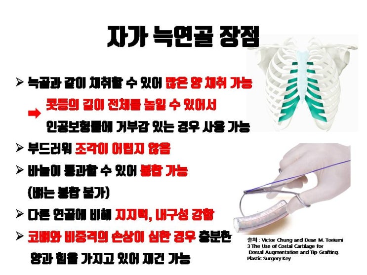  자가늑연골은 코수술 시 만능인 재료일까요? 그 실상을 낯 낯이 파헤쳐드립니다.!!!