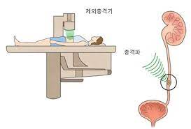  요석결석 체외충격파쇄석술 목적순서방법 부작용금기환자주의사항 준비사항 시술전후관리 간호중재