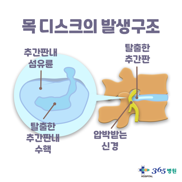  [창원마산 척추관절 디스크 365병원] 목디스크