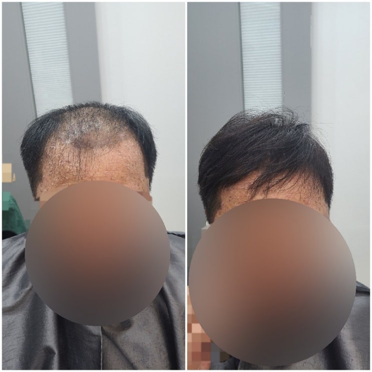  보톡스증모술보다 덕후누나가 더 좋아 [춘천가발 김호증모]