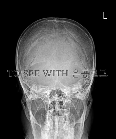  SKULL TOWNE PROJECTION (머리 전후 축방향 촬영)