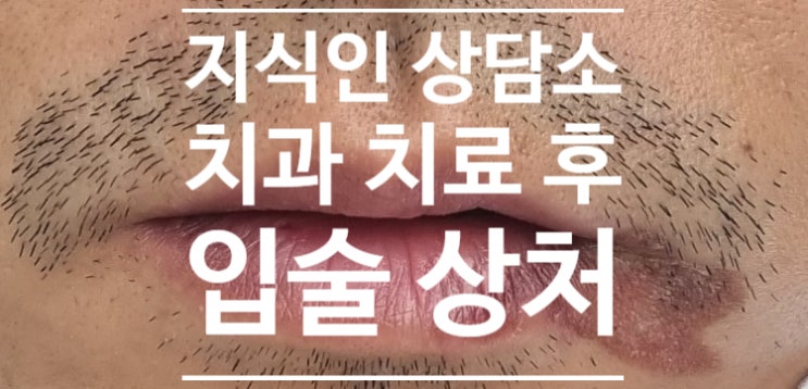 지식인 상담소) 치과치료받고 입술과 주변 피부가 불편해요, 입술 염증, 구각구순염(angular cheilitis)?