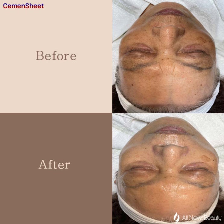  배곧피부관리 올뉴뷰티에서 노화피부를 동안피부로 만들어주는 세멘시트 로 1회만에 좋아진 후기