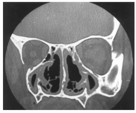 위축성 비염 Atrophic rhinitis, Ozena, 취비증, 냄새코염