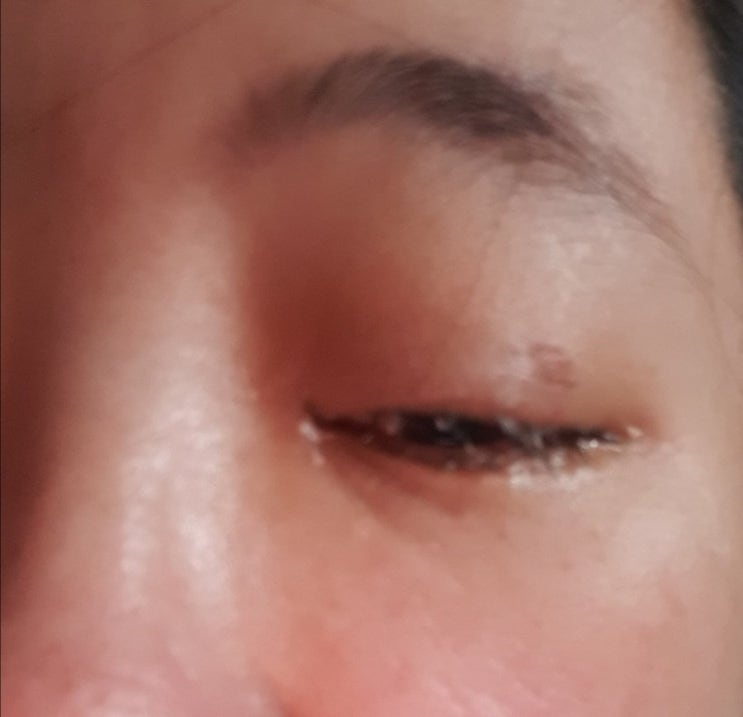  망막박리라니!눈건강에 무관심했던 후회란......