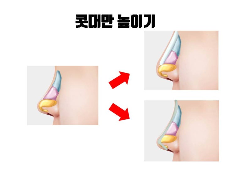  콧대만 수술할 수는 있어요. 하지만 결과는 단연코 만족스럽지 못 할 거에요!!!