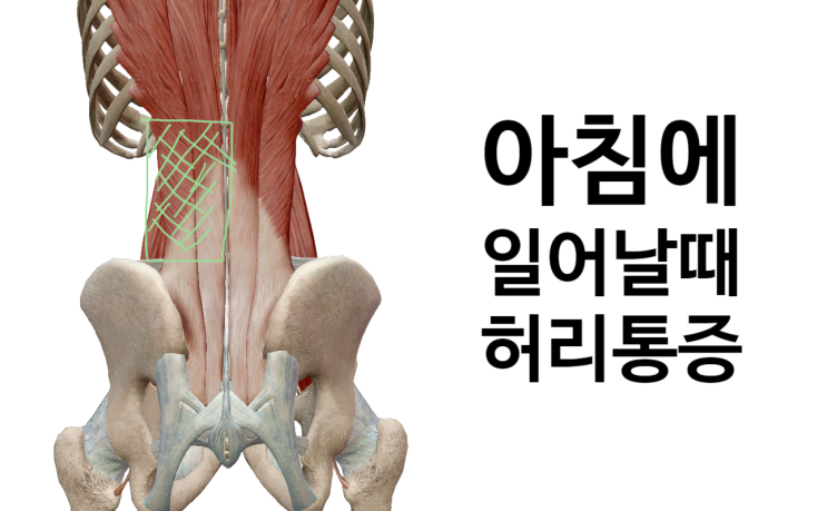 아침에 일어날 때 허리가 아파요[영통 새움한의원]