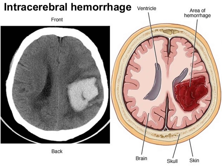뇌내출혈 (ICH ; Intracerebral hemorrhage)