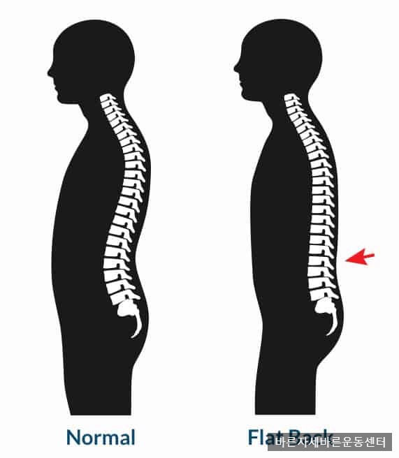  [서래마을PT] 편평등(Flat back)자세에 대해서..