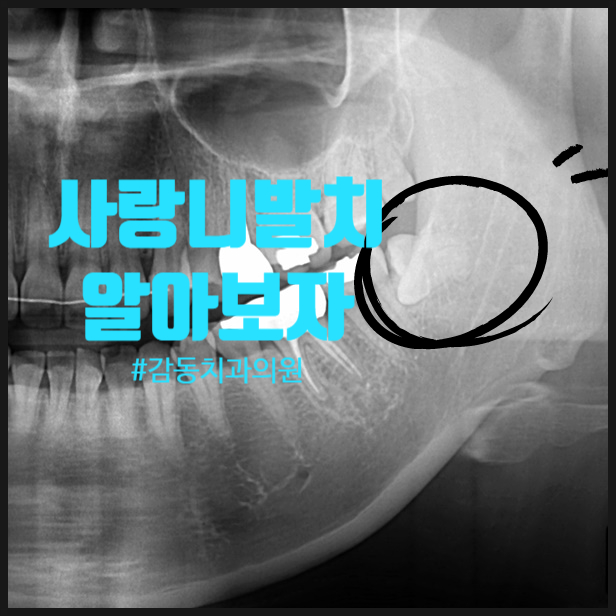  당감동 감동 치과 사랑니발치 후 통증