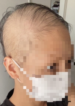  모더나 접종 후 탈모 부작용 온 일본 20대 여성 충격