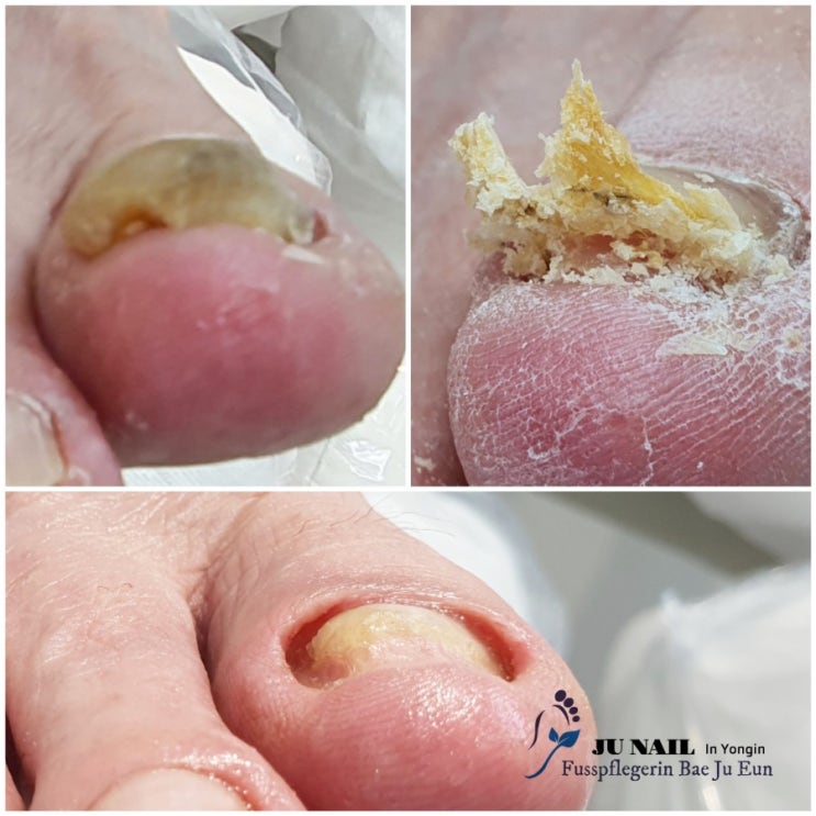 할아버지의 두껍고 아픈발톱 관리후기/성남수원수지보정동백죽전동/주네일/무좀파고드는내향성발톱손톱변형전문점 할아버지의 두껍고 아픈발톱 관리후기/성남수원수지보정동백죽전동/주네일/무좀파고드는내향성발톱손톱변형전문점