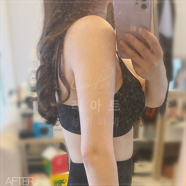  레아트성형외과에서 찾아보자팔뚝의 숨겨진 일자라인
