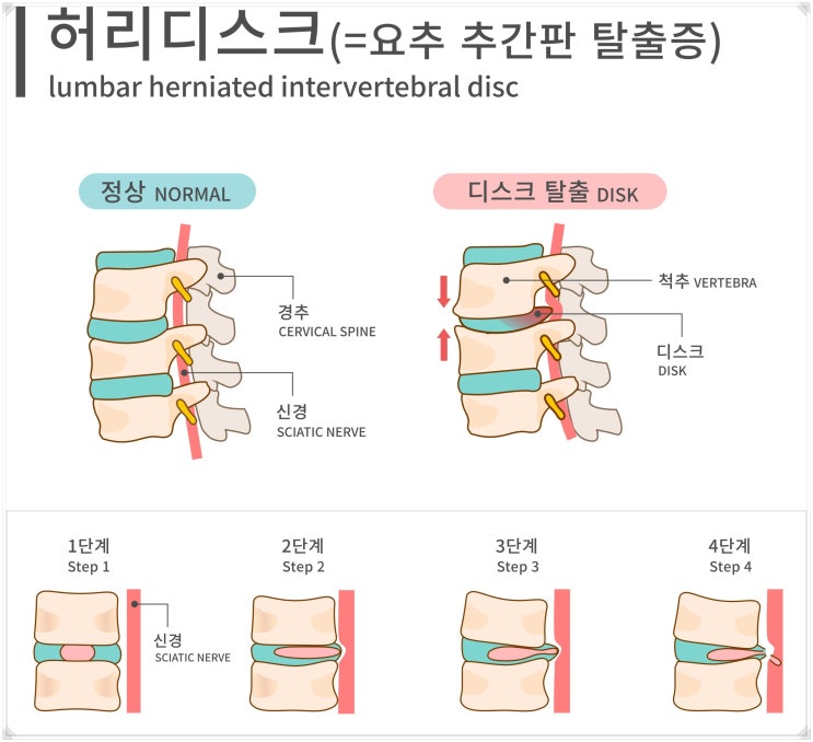  가산 허리디스크 체외충격파, 병원 선택 전 반드시 확인할 것?