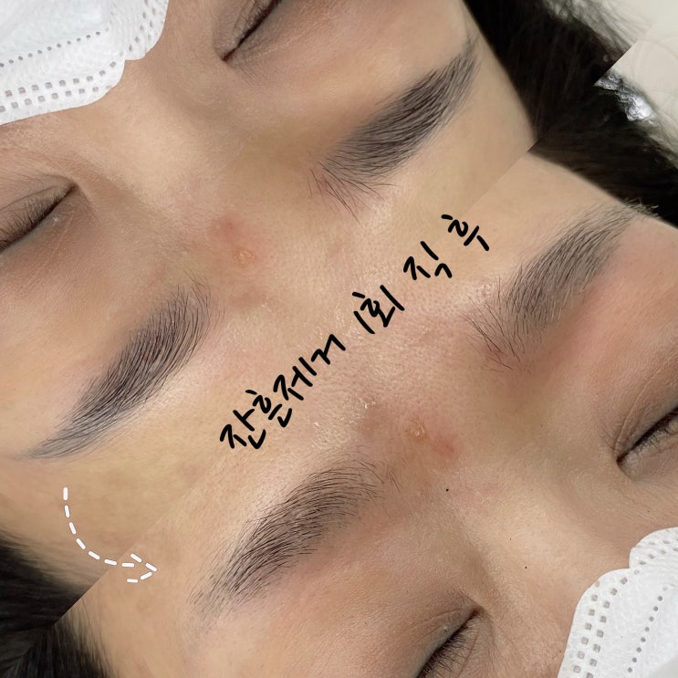  천안 눈썹문신 : 제거도 시술 경험이 많은곳에서 해야