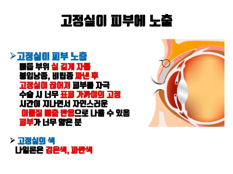  절개 쌍꺼풀 후 쌍꺼풀 라인에 검은색 혹은 파란색 실이 피부를 뚫고 노출될 수 있어요. 너무 놀라지 마시고 수술 받은 병원에서 바로 진료 받으세요!!!