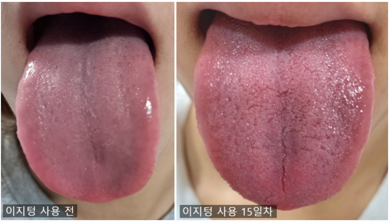 신개념 액체혀클리너 [이지텅] 사용하고 입냄새, 백태 등 입 속 세균 박멸하세요!!
