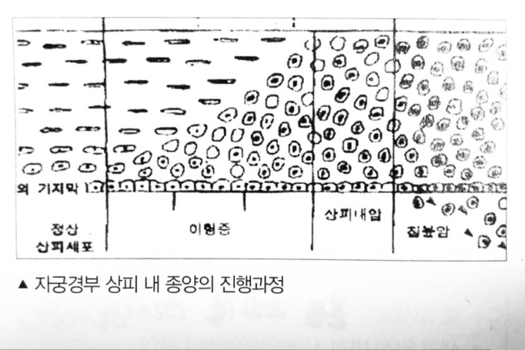  [원추절제술] 수술 일주일 후 외래 후기