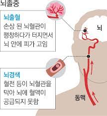  뇌경색 뇌졸중종류 원인병태생리 전조증상징후 약물수술치료 합병증예후 허혈성혈전색전증 간호중재케이스 문헌고찰