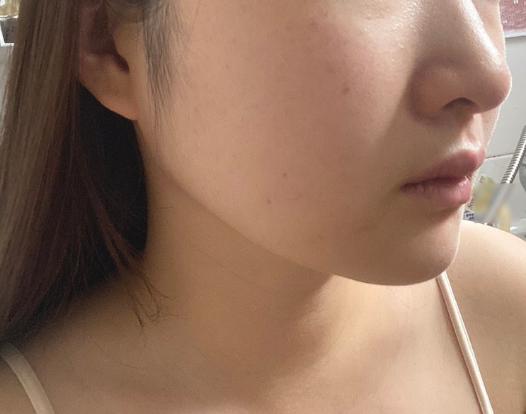  대구 인모드 리프팅 레이저 / fx, 포마 2차후기 - 효과시기, 멍, 가격, 부작용