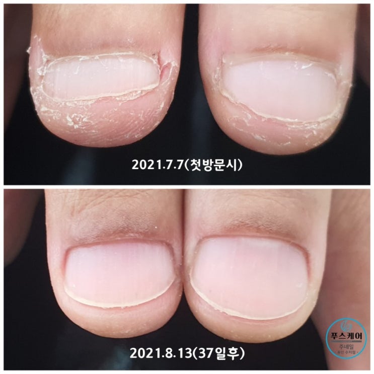 물어뜯는 손톱 1개월 6일만에 이렇게 바뀌었습니다./성남수원수지보정동백죽전동/주네일/무좀파고드는내향성발톱손톱변형전문점 물어뜯는 손톱 1개월 6일만에 이렇게 바뀌었습니다./성남수원수지보정동백죽전동/주네일/무좀파고드는내향성발톱손톱변형전문점