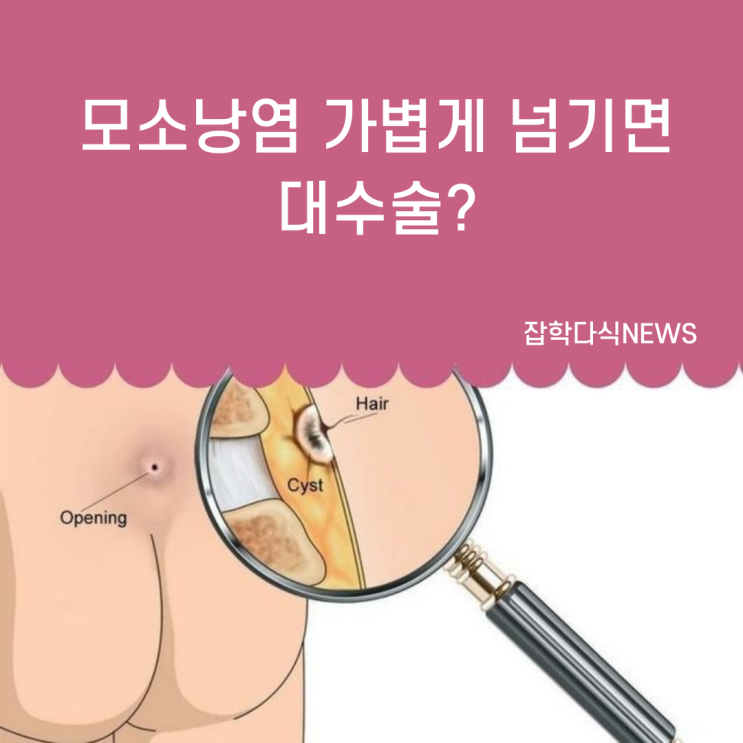  모소낭염 가볍게 넘기면 대수술?