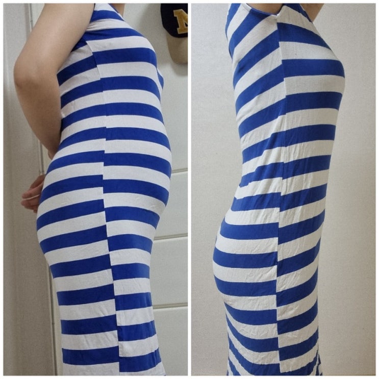 복부 지방분해주사로 다이어트 효과 본 후기