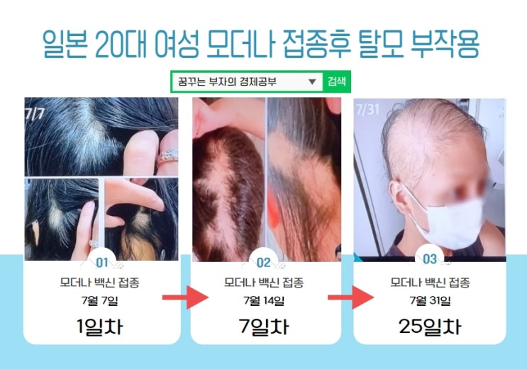  일본 20대 여성 모더나 백신 접종후 탈모 부작용!